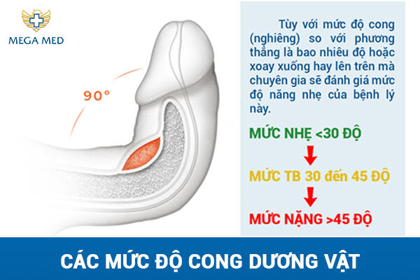 các mức độ cong dương vật
